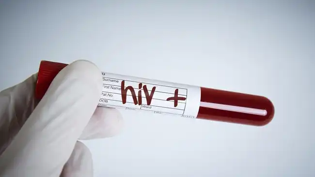 Ilustrasi HIV