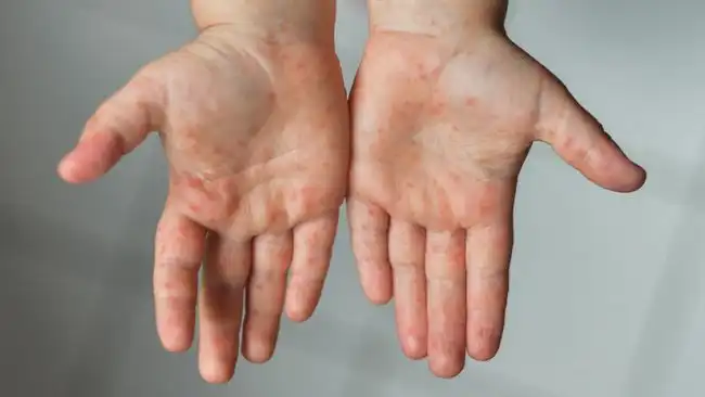 Kasus Campak
